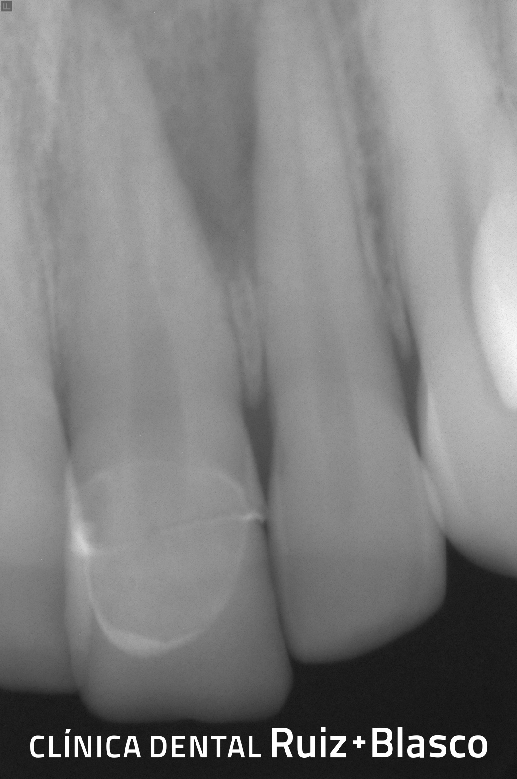 Endodoncia