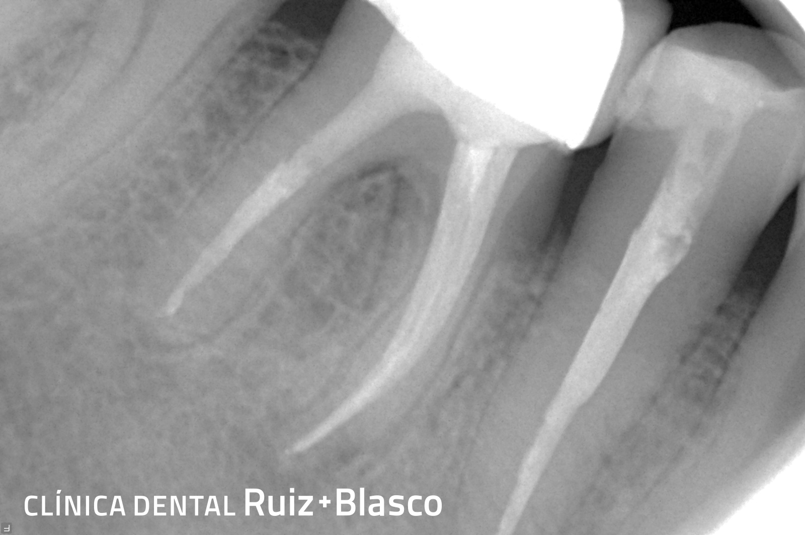 Endodoncia